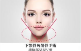 脸骨大,揭秘磨骨瘦脸术的神奇效果