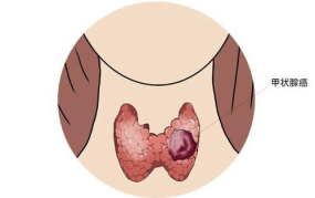 甲状腺癌能治好吗,治愈之路与希望之光