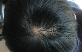 最近突然头发稀少了什么原因,揭秘常见原因与应对策略